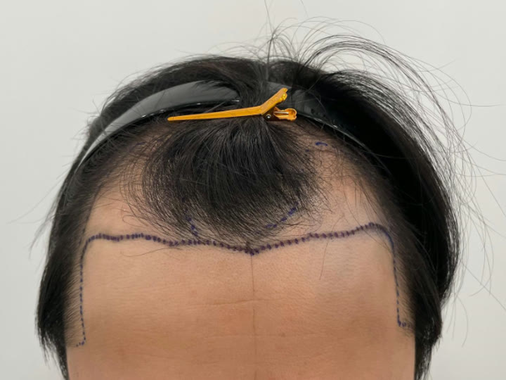 같은 분의 수술 전 사진